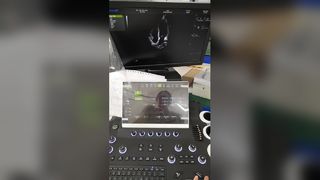 Wózkowy system diagnostyki ultradźwiękowej z kolorowym dopplerem BR-US01